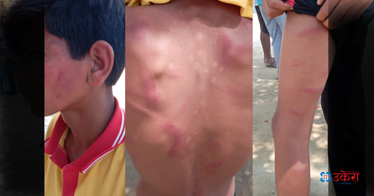 ‘होमवर्क’ नगरेको निहुँमा विद्यार्थी कुट्ने शिक्षक पक्राउ, विद्यार्थी अस्पताल भर्ना